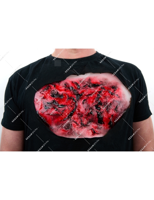 Brulure thermique thorax