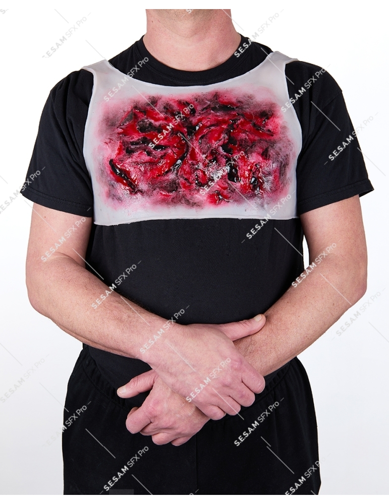 Brulure thermique thorax