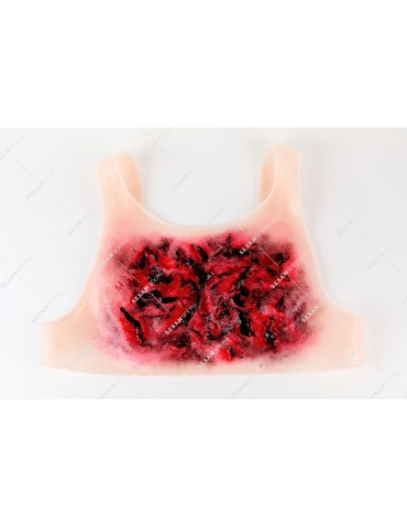 Brulure thermique thorax