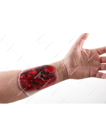 Brûlure thermique grave 2