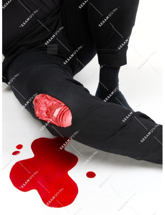 Fracture ouverte de la rotule