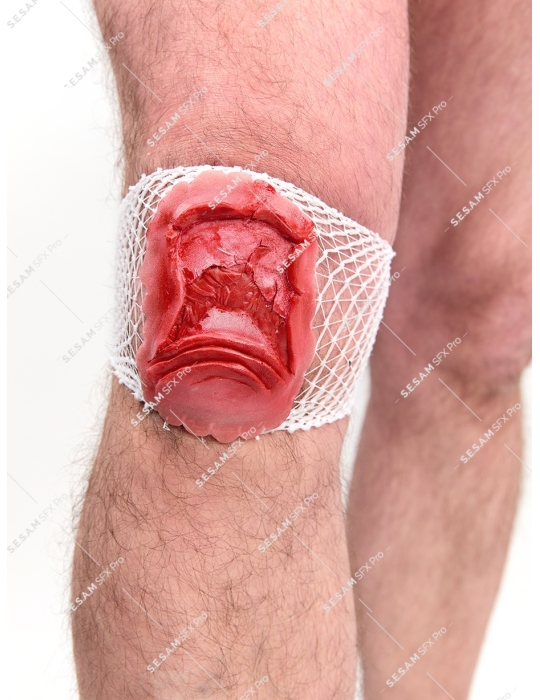 Fracture ouverte de la rotule