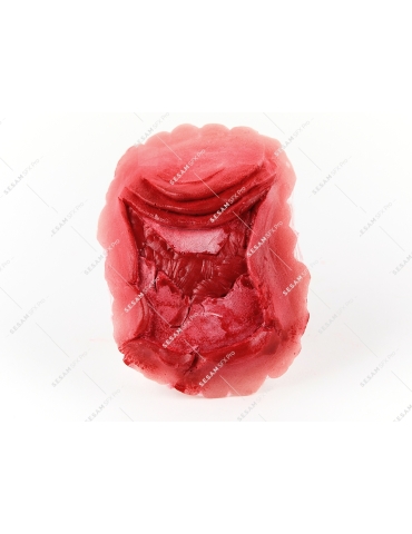 Fracture ouverte de la rotule