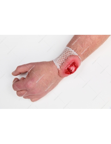 Fracture ouverte du poignet 2