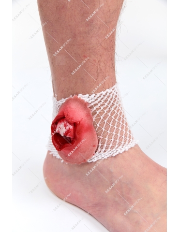 Fracture ouverte malléole 2