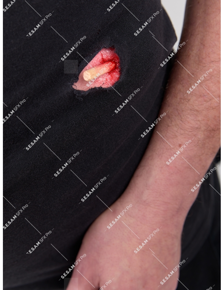 Grosse plaie avec corps étranger