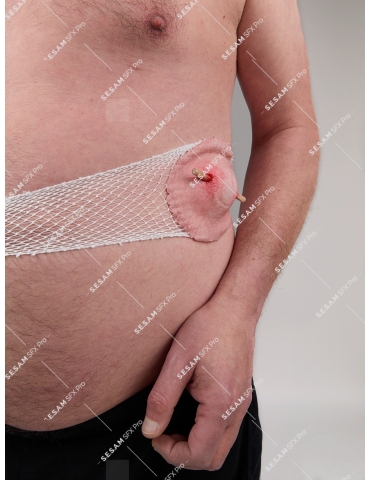 Grosse plaie avec corps étranger 2